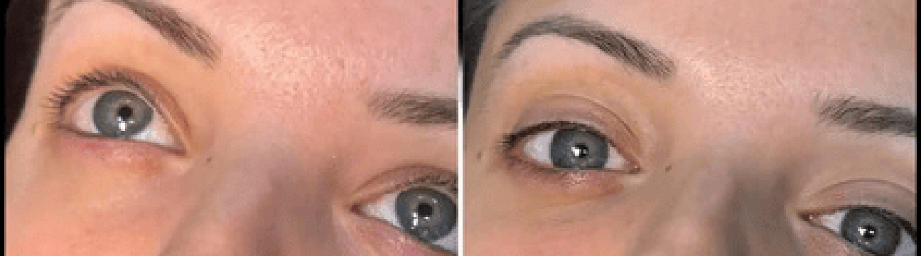 dermalfillers